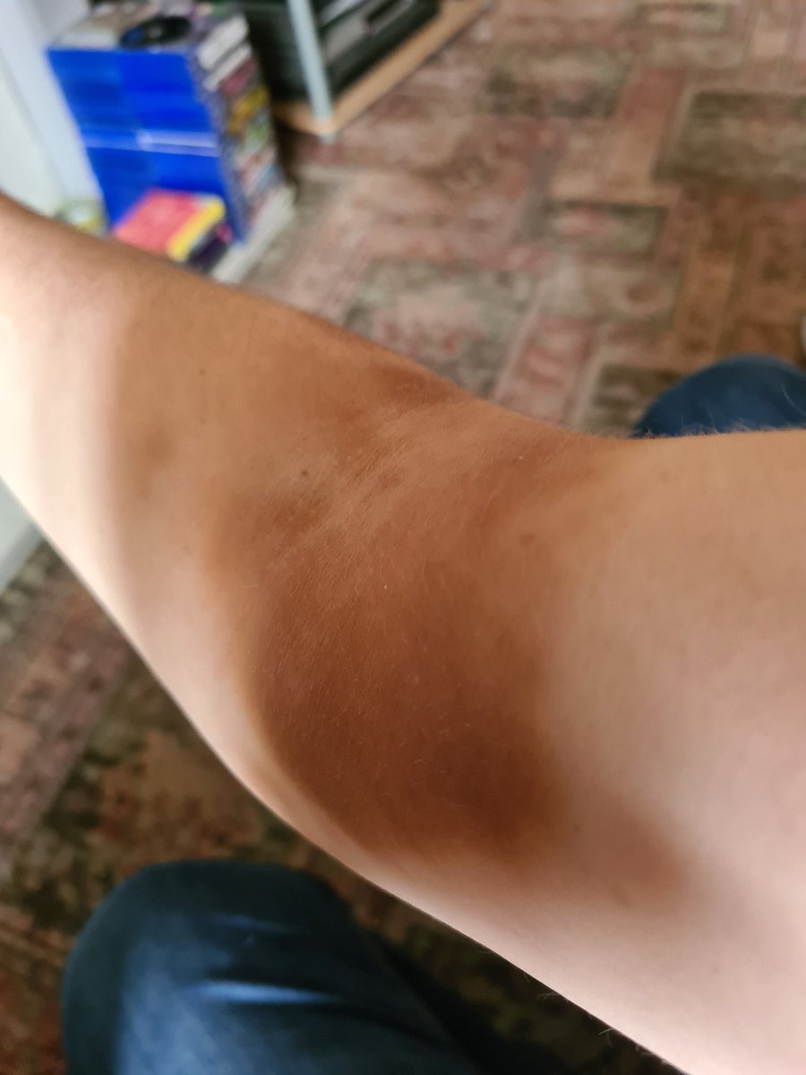 ShowMeFamily's tweet photo. So apparently iron infusion staining can be permanent. I don't remember the hospital staff telling me that..... https://t.co/z1XND1m7GI