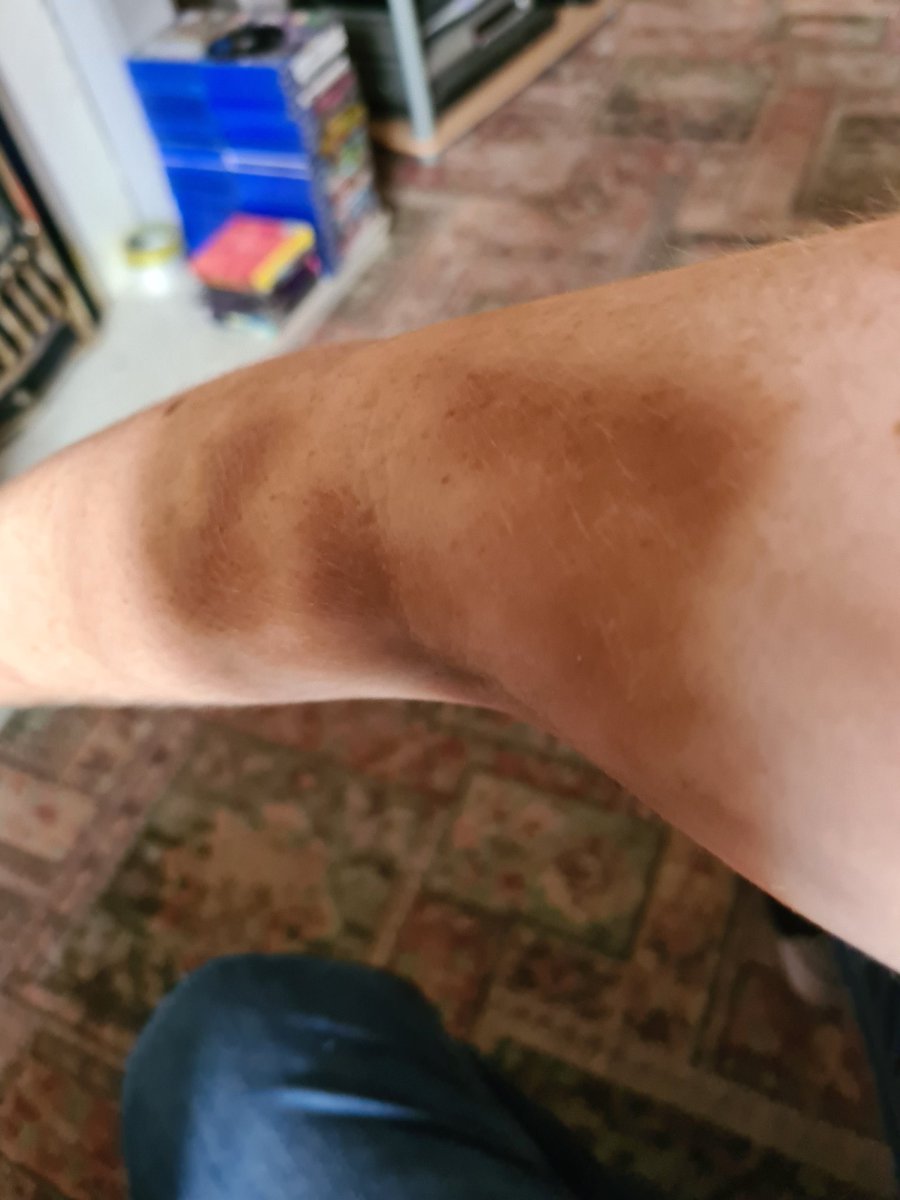 ShowMeFamily's tweet photo. So apparently iron infusion staining can be permanent. I don't remember the hospital staff telling me that..... https://t.co/z1XND1m7GI