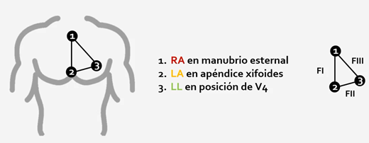 smexcardiologia's tweet photo. Derivaciones modificadas por Fontaine 👇

➡️Aumentan sensibilidad de ondas épsilon

➡️En ECG la onda épsilon es el hallazgo más específico pero sólo visto en 30% de los pacientes con displasia ventricular derecha arritmogénica https://t.co/0PnFjhfAbb