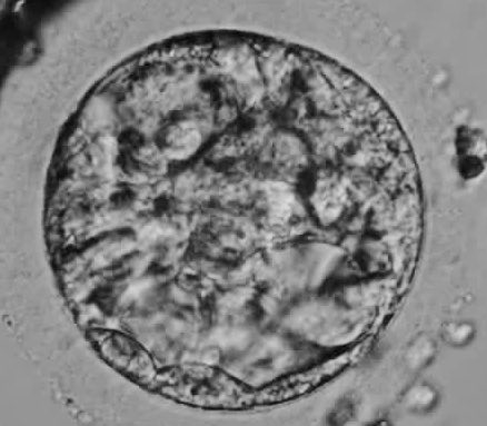 faizal_obgyn's tweet photo. Kualiti embrio adalah sgt penting bg menentukan kejayaan IVF. Gred embrio sgt mempengaruhi kebolehlekatan embabies. Sekiranya kualiti terjejas, pekembangan embrio didalam rahim jugak agak terbatas dan sering mengakibatkan keguguran. #embryo #ttc #embryoquality https://t.co/gE3kYxz6Fw