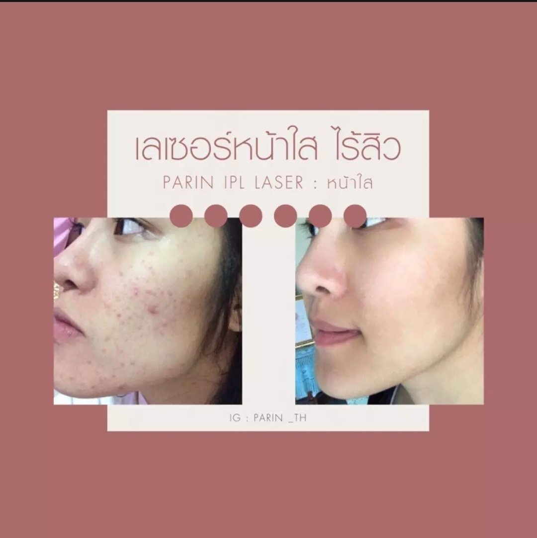 Pukmudpro's tweet image. #หน้าใส​ 💢​PARIN IPL LASER💢
กำจัดขน และ หน้าใส ซื้อยกเซตในราคาสุดคุ้ม  1650.-

สั่งซื้อ​ได้ที่​👇
7mem.org/gkxfv

เครื่องเลเซอร์กำจัดขน 600,000 ช็อต

ของแท้จากแบรนด์ PARIN

#ปักหมุดโปร​ #เลเซอร์​  #Parin