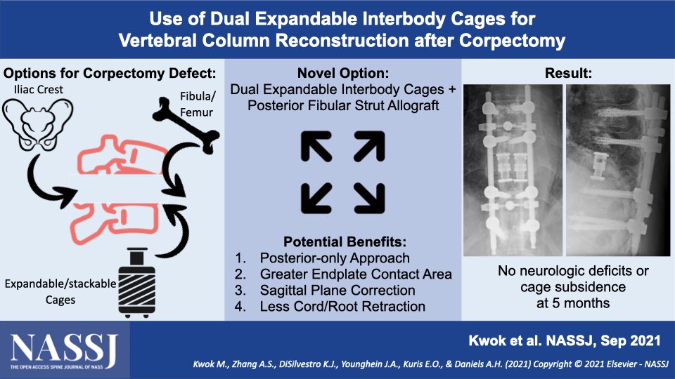 NASSJ (@nassjournal) on Twitter photo “A case report illustrating the feasibility of employing dual expandable cages as an option for achieving greater endplate contact area while reconstructing thoracolumbar corpectomy defects” https://bit.ly3Bpy8fp <a href="/BrownOrthoSurg/">Brown Orthopaedics</a> <a href="/BrownOrthoRes/">Brown Orthopaedic Research</a> <a href="/NASSspine/">NASS</a> #orthotwitter" “A case report illustrating the feasibility of employing dual expandable cages as an option for achieving greater endplate contact area while reconstructing thoracolumbar corpectomy defects” https://bit.ly3Bpy8fp <a href="/BrownOrthoSurg/">Brown Orthopaedics</a> <a href="/BrownOrthoRes/">Brown Orthopaedic Research</a> <a href="/NASSspine/">NASS</a> #orthotwitter"