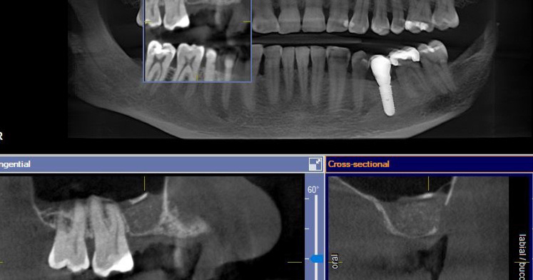 MischInstitute's tweet photo. Congratulations to Dr. Daniel M. Winter from Manhattan, KS. Completed his first lateral wall sinus graft following his Misch Resnik course completion! Great job doctor! https://t.co/ylyp8wiSm1