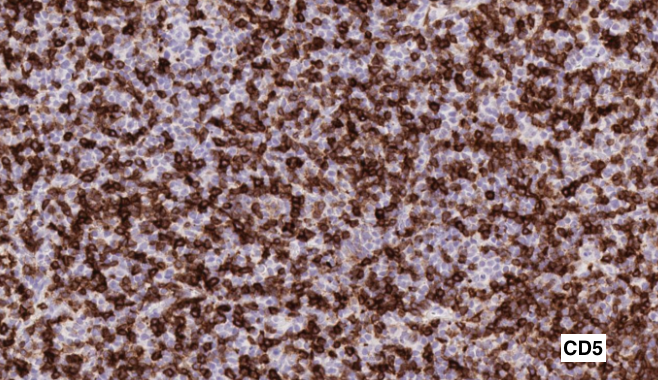 SibaElHussein's tweet photo. #LessonsfromtheFridayUnknowns follicular lymphoma (FL) with a T-cell rich background that could be misinterpreted as T-cell lymmphoma, higher power reveals a sizeable subset of cells (FL cells) negative for CD5, shown to us by @ljmedeirosMD ➡️https://t.co/gN1xuWMrDS #hemepath https://t.co/JBvuJVbJl8