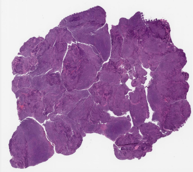 SibaElHussein's tweet photo. #LessonsfromtheFridayUnknowns follicular lymphoma (FL) with a T-cell rich background that could be misinterpreted as T-cell lymmphoma, higher power reveals a sizeable subset of cells (FL cells) negative for CD5, shown to us by @ljmedeirosMD ➡️https://t.co/gN1xuWMrDS #hemepath https://t.co/JBvuJVbJl8