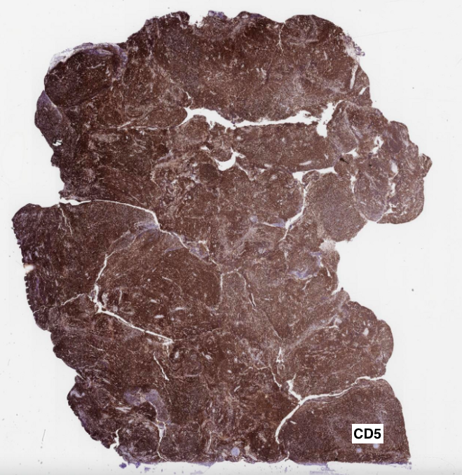 SibaElHussein's tweet photo. #LessonsfromtheFridayUnknowns follicular lymphoma (FL) with a T-cell rich background that could be misinterpreted as T-cell lymmphoma, higher power reveals a sizeable subset of cells (FL cells) negative for CD5, shown to us by @ljmedeirosMD ➡️https://t.co/gN1xuWMrDS #hemepath https://t.co/JBvuJVbJl8