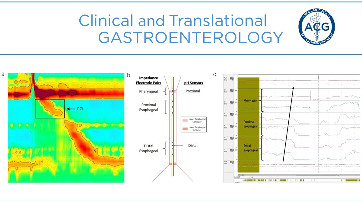ACG_CTG's tweet photo. In #CTGJournal:
Impaired Proximal Esophageal Contractility Predicts Pharyngeal Reflux in Patients w/ Laryngopharyngeal Reflux Symptoms
Sikavi, et al.
➡️ https://t.co/3St7R15JK4
https://t.co/f2J4U1JKrH
#gastroenterology #openaccess @brianjacobsonmd @LevinthalDavid @PopovVioleta https://t.co/nbe4CFwhcS