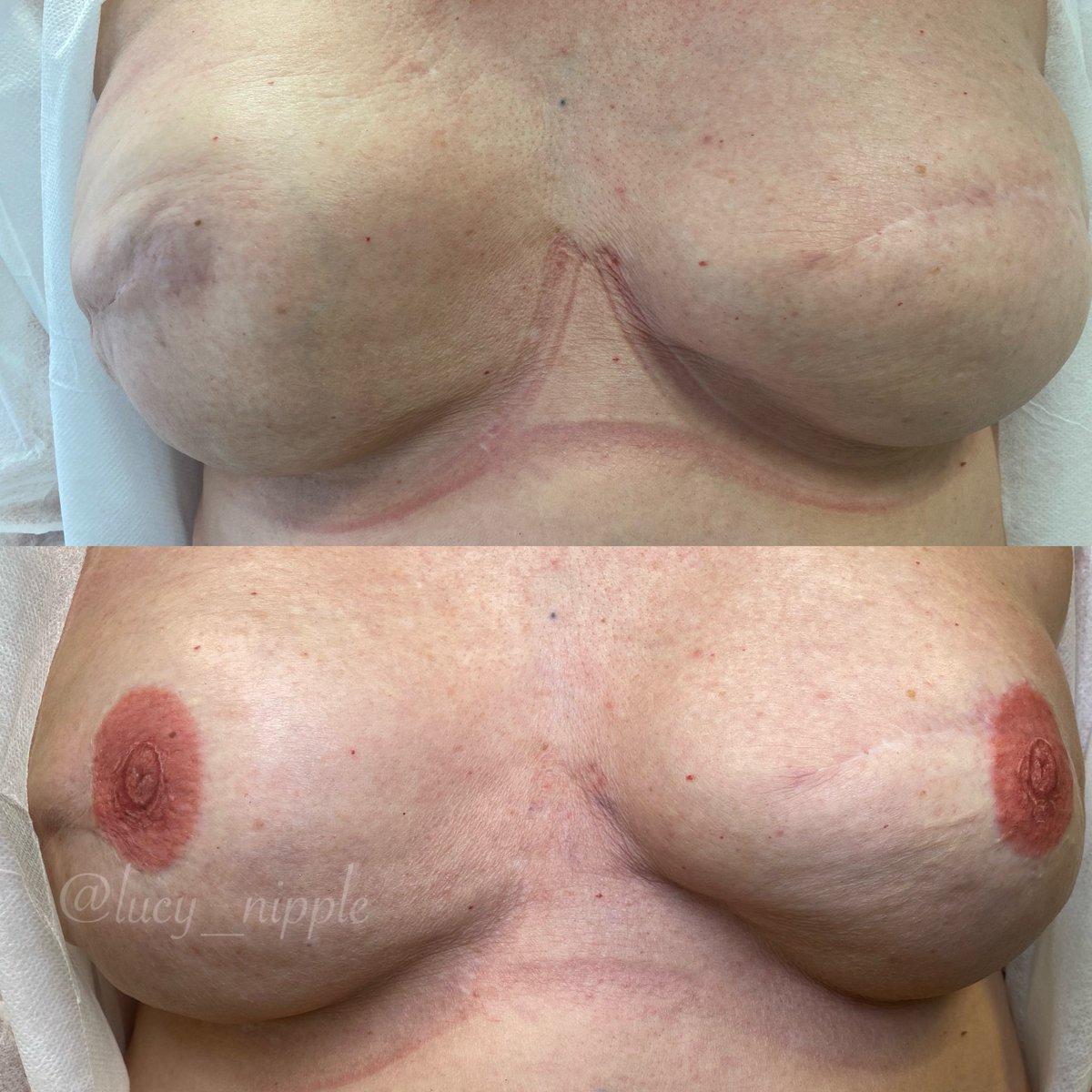 Lucy Thompson (@lucy_nipple) on Twitter photo Creating balance & wholeness with incredible 3D Nipple tattoos that won’t fade away!!! ✨
Free clinics available thanks to <a href="/nipcharity/">Nipple Innovation Project</a> 💕
Please #rt for #BreastCancerAwarenessMonth
#thisisart
#BreastCancerAwareness
#wholeagain Creating balance & wholeness with incredible 3D Nipple tattoos that won’t fade away!!! ✨
Free clinics available thanks to <a href="/nipcharity/">Nipple Innovation Project</a> 💕
Please #rt for #BreastCancerAwarenessMonth
#thisisart
#BreastCancerAwareness
#wholeagain