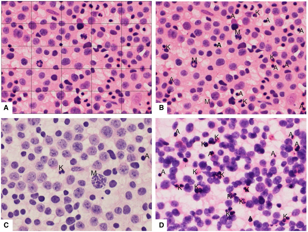 Cancer Cytopathology (@cancercytopath) on Twitter photo New! Mitosis-Karyorrhexis Index (MKI) scoring by digital image visual assessment (DIVAS) on FNA smears of neuroblastoma is objective and reproducible. acsjournals.onlinelibrary.wiley.com/doi/10.1002/cn… <a href="/drsradhika/">Radhika Srinivasan</a> #CytoPath #FNAPath New! Mitosis-Karyorrhexis Index (MKI) scoring by digital image visual assessment (DIVAS) on FNA smears of neuroblastoma is objective and reproducible. acsjournals.onlinelibrary.wiley.com/doi/10.1002/cn… <a href="/drsradhika/">Radhika Srinivasan</a> #CytoPath #FNAPath