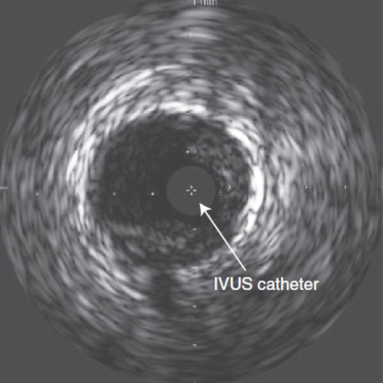 ***IVUS Basics*** Tweetorial #cardiotwitter 1/ IVUS Guide Catheter