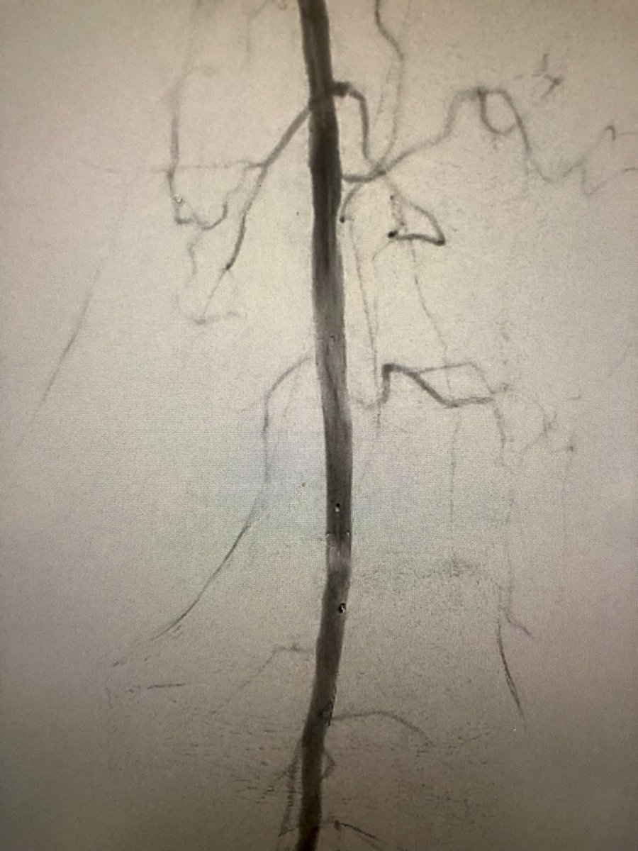 DrDukesVIR's tweet photo. Students, residents, and fellows: remember, always use protection. | R4 rest pain - culprit captured & recalcitrant stenosis treated w/ @AbbottCardio #supera - pain resolved. @SIRRFS @SIR_ECS @SIRspecialists @Medtronic @MedtronicAPV #spiderFX #endovascular #twitIR #PAD https://t.co/kl6UsKhmf7