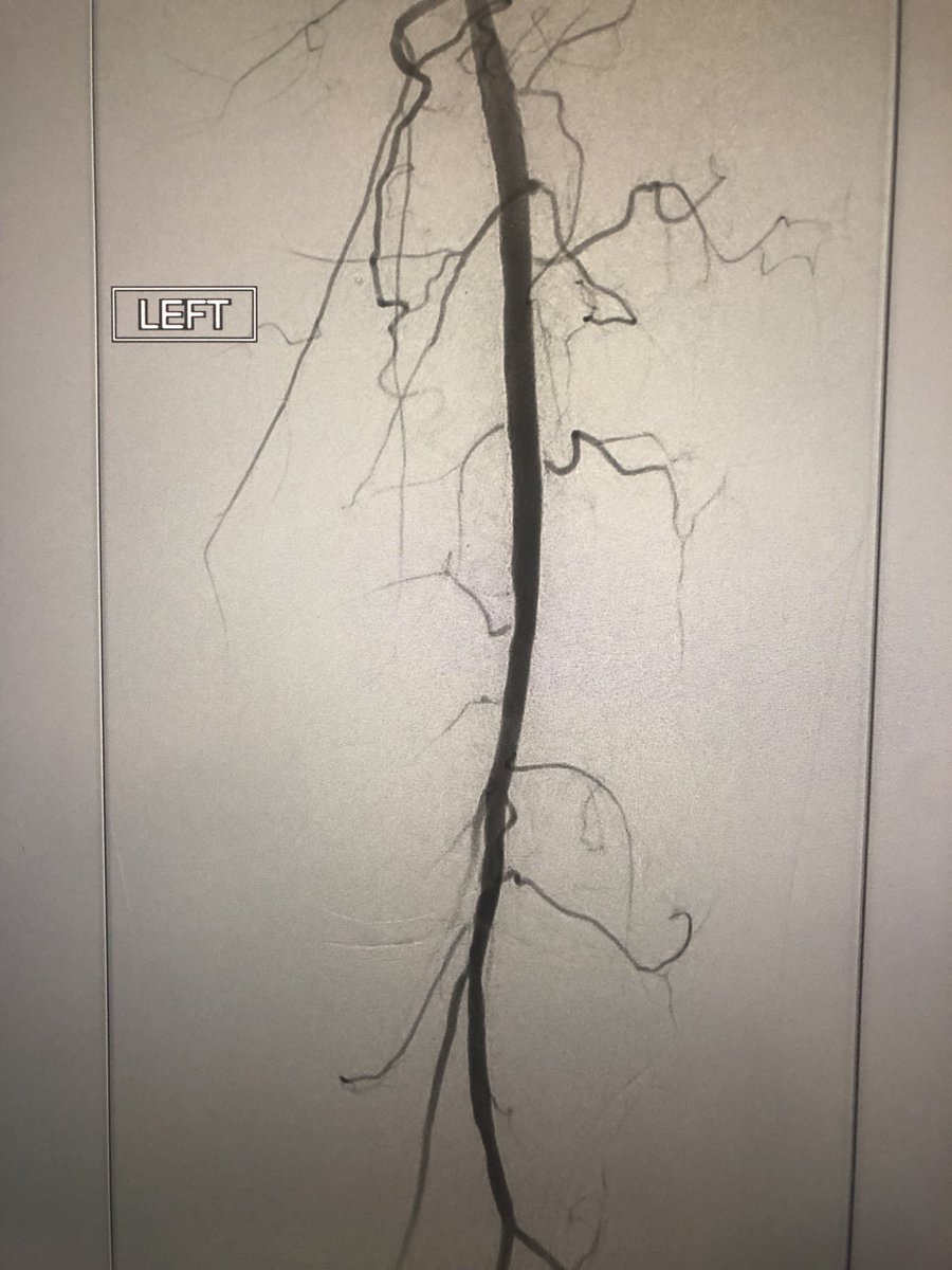 Students, residents, and fellows: remember, always use protection. | R4 rest pain - culprit captured &amp; recalcitrant stenosis treated w/ <a href="/AbbottCardio/">Abbott Cardiovascular</a> #supera - pain resolved. <a href="/SIRRFS/">SIR RFS</a> <a href="/SIR_ECS/">SIR ECS</a> <a href="/SIRspecialists/">Society of Interventional Radiology</a> <a href="/Medtronic/">Medtronic</a> <a href="/MedtronicAPV/">MedtronicAPV</a> #spiderFX #endovascular #twitIR #PAD