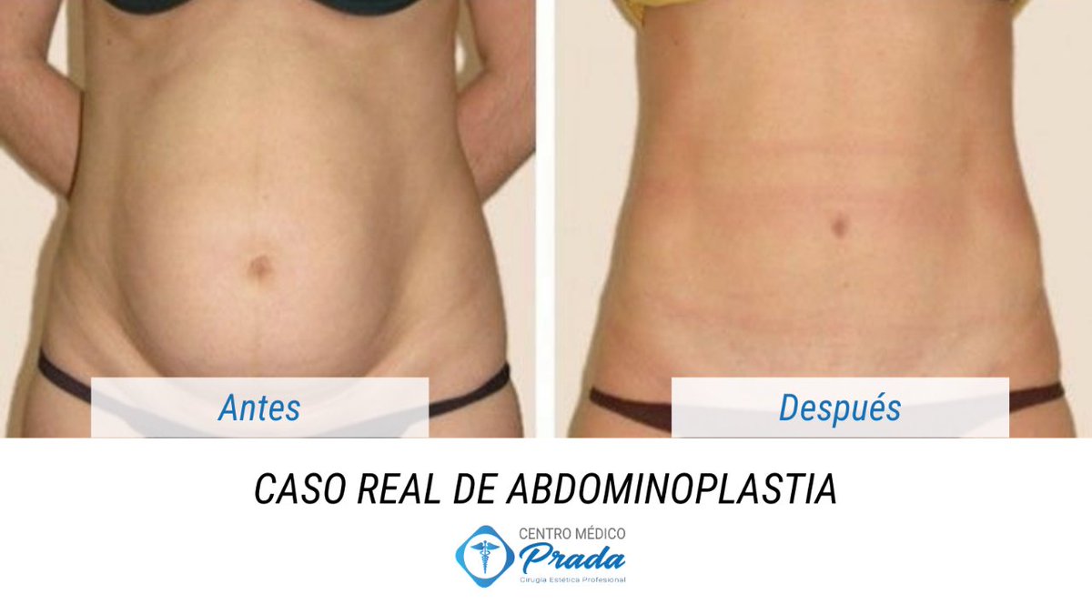 CMedicoPrada's tweet photo. La #abdominoplastia es una intervención que proporciona resultados espectaculares, ya que proporciona un vientre firme y plano en los casos en que hay abombamiento por debilidad muscular o exceso de grasa. Os mostramos un caso real de una paciente. 
🌐https://t.co/YgzzJLHuCE https://t.co/PHBPGk6ONB