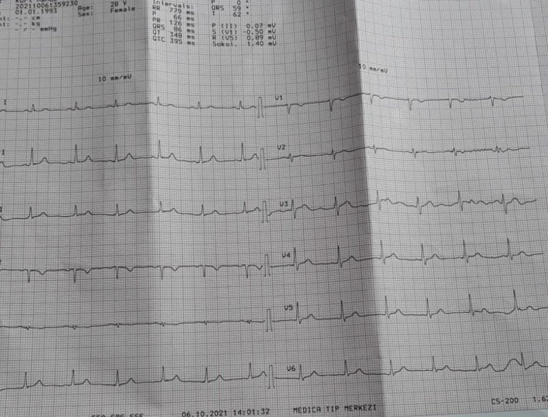 Fatih Mehmet UÇAR (@dr_fatihucar) on Twitter photo What dou you think about pre- excitation? <a href="/YalinKivanc/">Kıvanç YALIN</a> <a href="/kamilgulsen/">Kamil Gülşen</a> <a href="/KanarBatur/">@baturkanar</a> <a href="/ayhankup/">ayhankup</a> <a href="/HakimIcu/">Hakim Noman ,MD,PHD,FHRS,FSCAI</a> What dou you think about pre- excitation? <a href="/YalinKivanc/">Kıvanç YALIN</a> <a href="/kamilgulsen/">Kamil Gülşen</a> <a href="/KanarBatur/">@baturkanar</a> <a href="/ayhankup/">ayhankup</a> <a href="/HakimIcu/">Hakim Noman ,MD,PHD,FHRS,FSCAI</a>