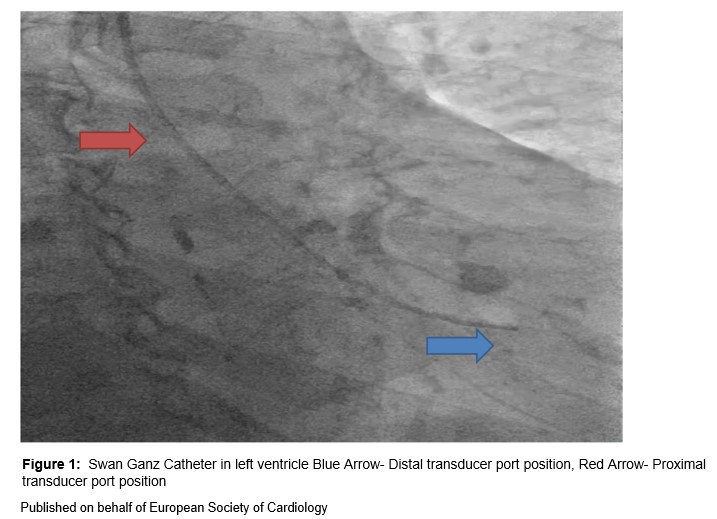 ESC_Journals's tweet photo. A novel technique for invasive aortic valve pressure gradient measurement using a 6Fr Swan-Ganz catheter https://t.co/HivoafnEnU #radialfirst @johncamm @cfcamm @EHJCREiC @aayshacader @FarhanaAra @TJ_Yeo @ANazmiCalik  @KardiologieHH @UjjwalRastogiMD @DLBHATTMD https://t.co/Q3bZy9TM0C