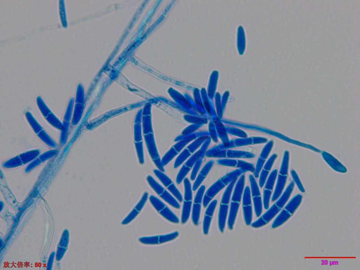 xmsunxhp's tweet photo. Eumycetoma， Fusarium solani https://t.co/aM1KYj2CIi