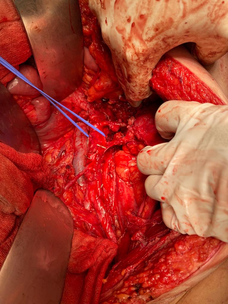 A challenging case; Post-chemotherapy Retroperitoneal Lymph Node Dissection for Mixed Malignant Germ Cell Testicular Tumors

<a href="/akcaoktay_/">Oktay</a>

#rplnd #urology #testiculercancer