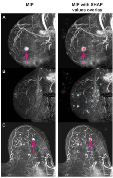 Applied_Rad's tweet photo. New Research | "We showed that it is possible to safely use #AI to dismiss breast screening #MRI without missing any malignant disease," states Eric Verburg, https://t.co/odA2my0aRp. @ISI_UMC. Read more > https://t.co/HDjxkqHUQc #Braccoimaging #BreastMRI #DenseBreast #RadRes https://t.co/TEPKSNHghv