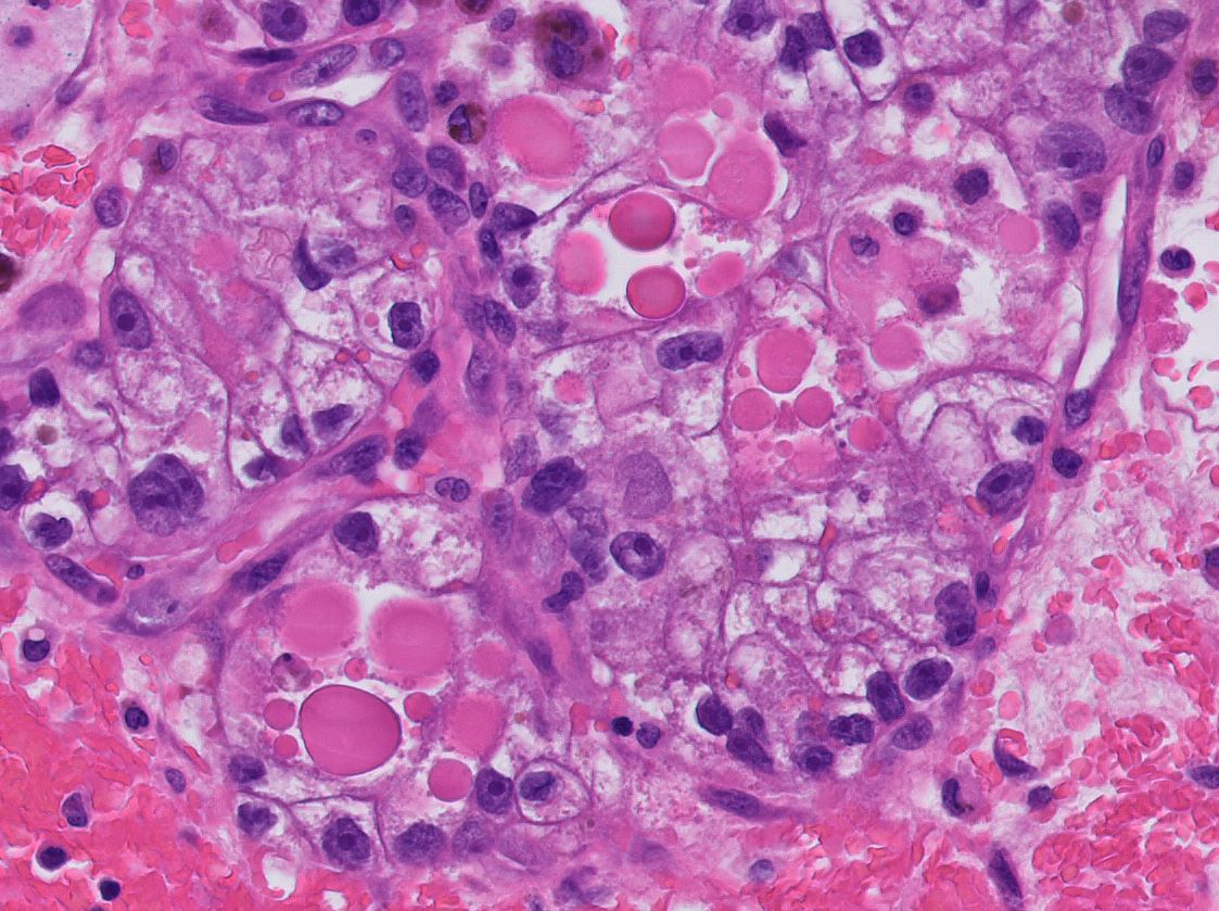 Clear cell renal cell carcinoma with prominent eosinophilic hyaline globules

This tumour is BAP1-inactivated (see ref and thread)

Ref: pubmed.ncbi.nlm.nih.gov/33210135/ <a href="/glom_busterMD/">Alex Gallan</a> 

#PathTwitter #GUPath <a href="/s_prendeville/">Susan Prendeville</a>  <a href="/mhassanaimc/">Masood Hassan</a> <a href="/slusagar/">Ankur Sangoi</a> <a href="/Williamson_SR/">Sean R Williamson MD</a>