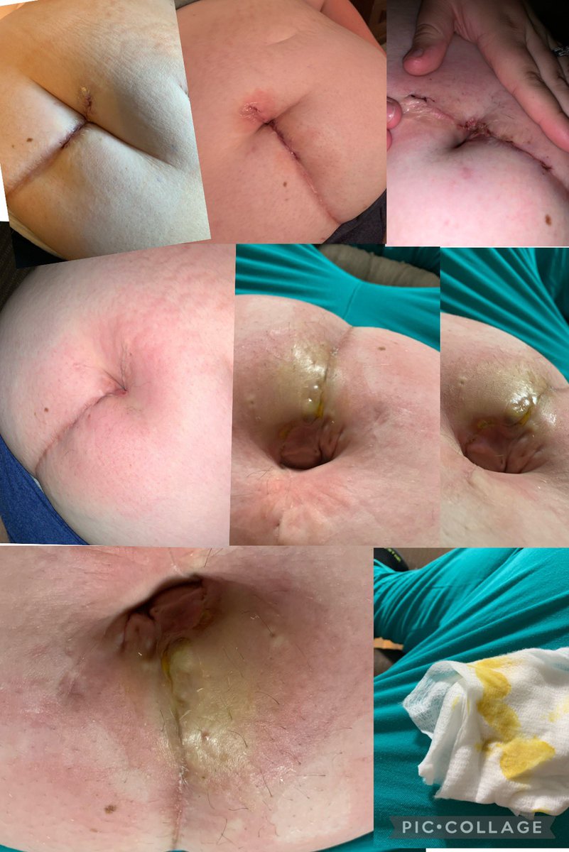 StephneyStrayer's tweet photo. Sorry for all the nasty pictures but here’s another one of my silent battles I’m currently dealing with all caused from my csection… My daughter is 7 months old and I’m on my 3rd surgery.. 😕 https://t.co/Iww10QBumx