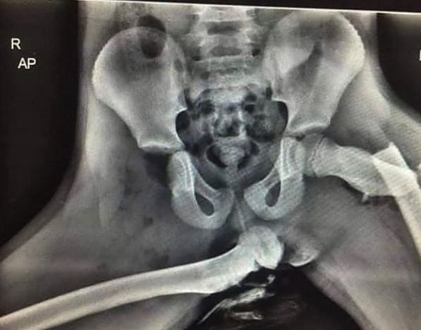 radRounds's tweet image. What is the mechanism here?  Something you should never do in a car... Answer = ow.ly/9cRf50GpKCC