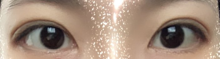 bigbadmii's tweet photo. 埋没して1ヶ月と1週間経った二重です👀
#水の森 #埋没 #二重埋没 https://t.co/RMD8kiuMV6