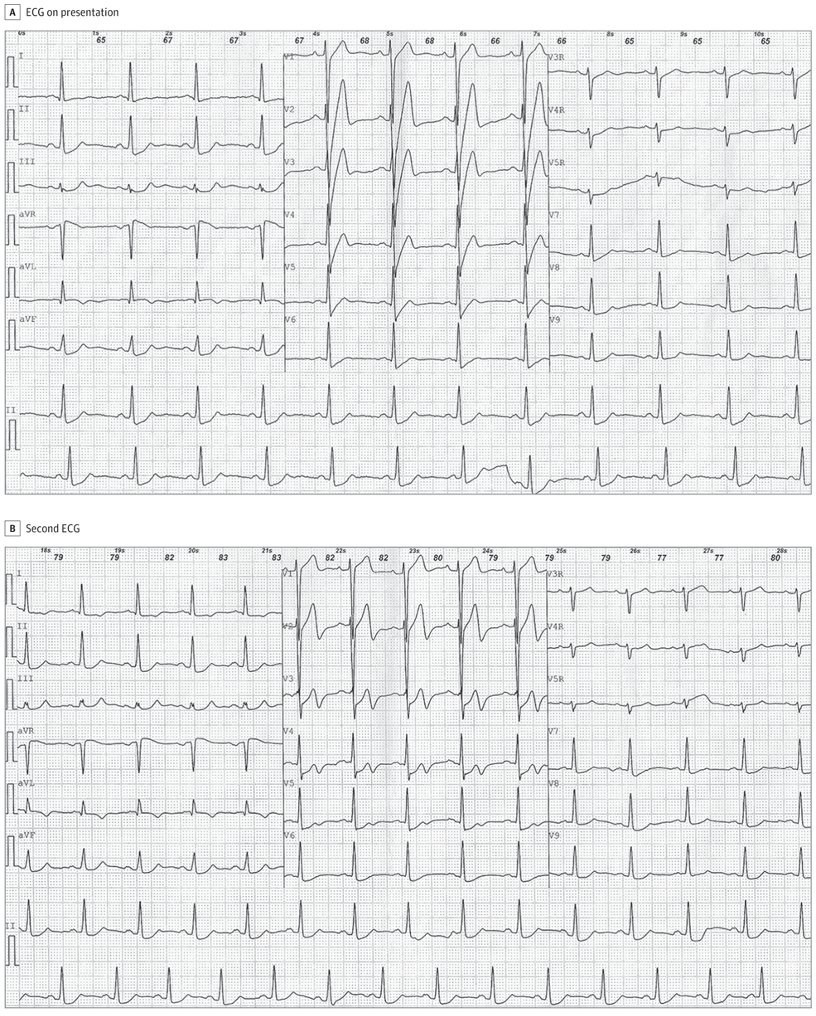 JAMA int medicine. de Winter and Wellens. Same patient. Patterns mean LAD acute occlusion or...LAD critical stenosis, respectively. #ECG