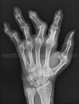 BoxingKingdom14's tweet photo. Deontay Wilder broke his finger early in the fight. As you can see on the X ray, he showed enormous courage by continuing to fight. #Warrior https://t.co/W96jkAa6OM