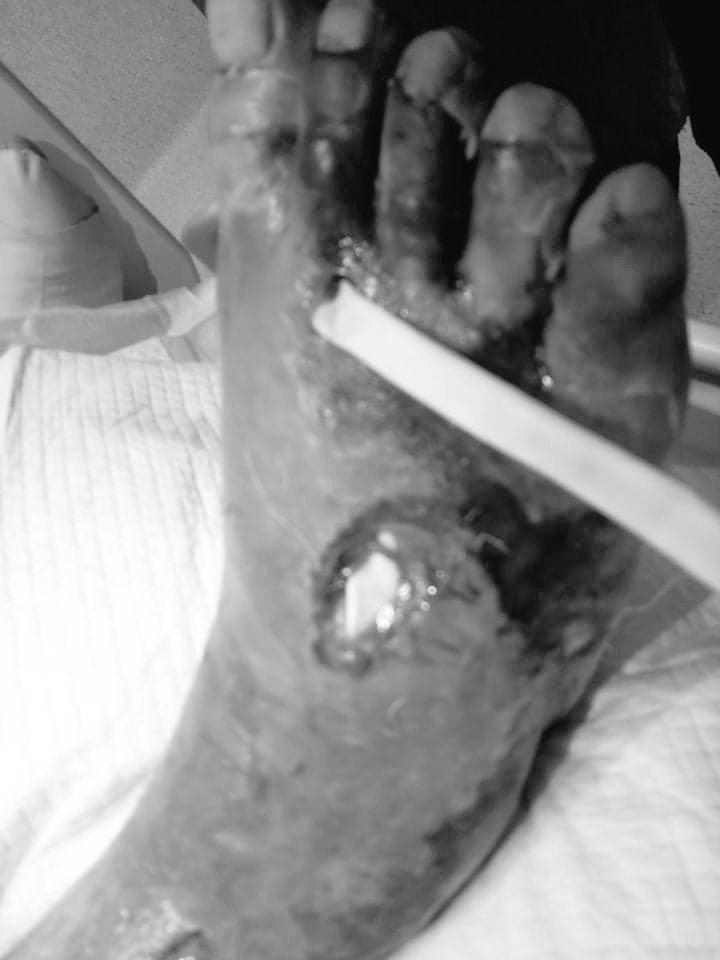 TW / Medical

Tatay Loreto has diabetes and  His legs needs to get amputated as soon as possible. Any bit of help is appreciated.

GCASH: 09677880281 (Lea May Roldan wife)
PAYMAYA/COINSPH: 09152756371
PAYP*L: paypal.me/dreamchrysler
BDO: 00104026098