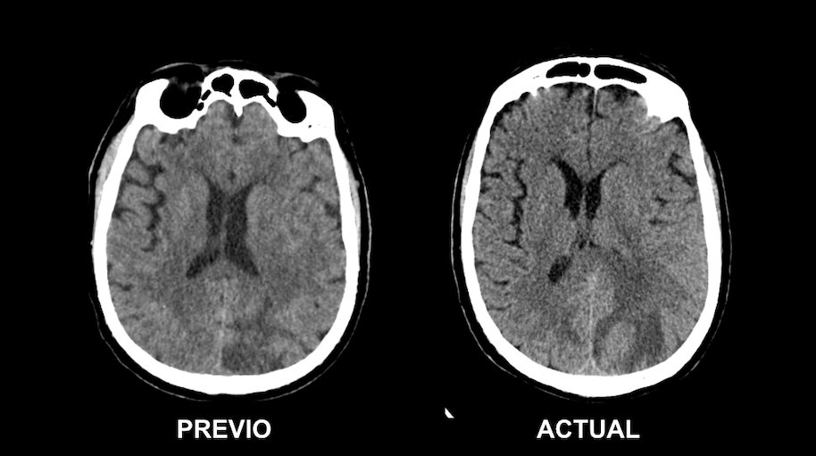 serammeA6SALUD's tweet photo. #CasosRAD_MOME
Varón de 70 años con hemiparesia derecha y disartria, sin criterios para trombolisis en código ictus. Se realiza endarterectomía de trombo flotante en la ACI izq y acude pocos días después con empeoramiento de la clínica. Se comparan TC.
@damedium @residentesSERAM https://t.co/dwOCl64HRN