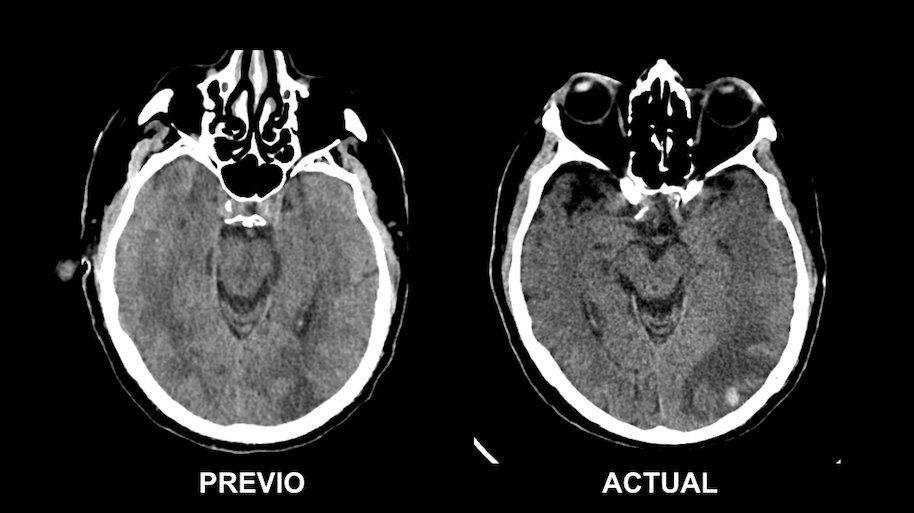 serammeA6SALUD's tweet photo. #CasosRAD_MOME
Varón de 70 años con hemiparesia derecha y disartria, sin criterios para trombolisis en código ictus. Se realiza endarterectomía de trombo flotante en la ACI izq y acude pocos días después con empeoramiento de la clínica. Se comparan TC.
@damedium @residentesSERAM https://t.co/dwOCl64HRN