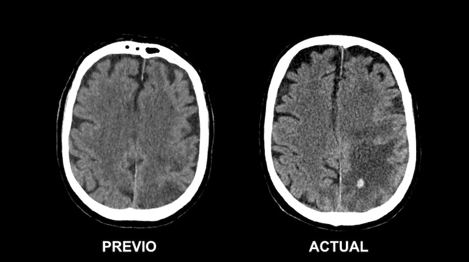 serammeA6SALUD's tweet photo. #CasosRAD_MOME
Varón de 70 años con hemiparesia derecha y disartria, sin criterios para trombolisis en código ictus. Se realiza endarterectomía de trombo flotante en la ACI izq y acude pocos días después con empeoramiento de la clínica. Se comparan TC.
@damedium @residentesSERAM https://t.co/dwOCl64HRN