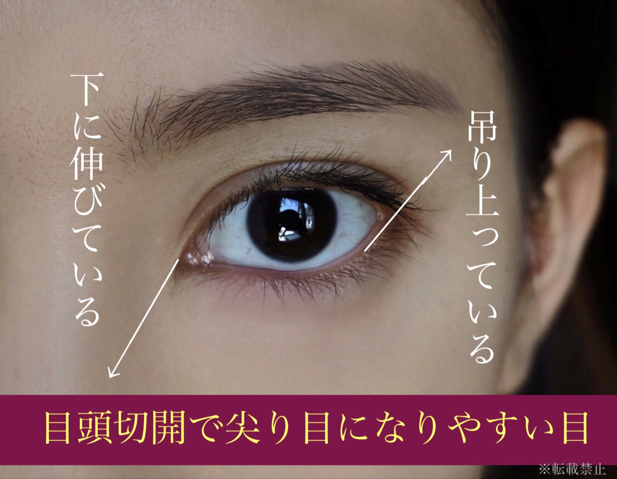 鼻整形の相談所 鼻翼縮小 小鼻縮小 鼻尖縮小 鼻尖形成 鼻中隔延長 プロテーゼ 二重整形 目頭切開 目頭切開は事前の目の状態で ある程度どのような変化になるのかは予測がつく 元々 目頭が下を向いていて 目尻がクッと上がっているタイプだと