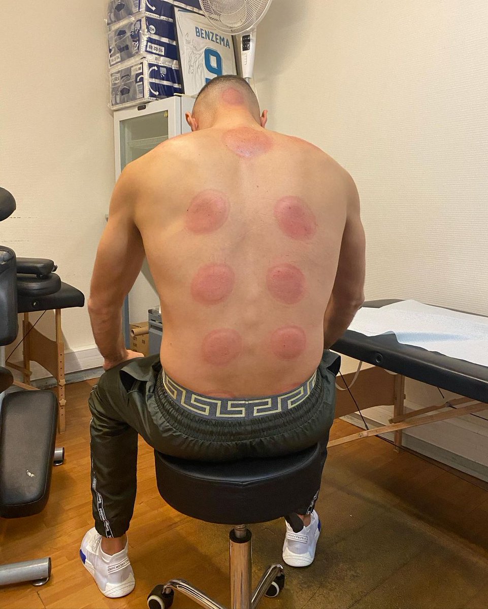 SC_ESPN's tweet photo. Todo premio tiene su sacrificio: así termina la espalda de Karim Benzema tras las sesiones de kinesiología. https://t.co/G207ifrgYw