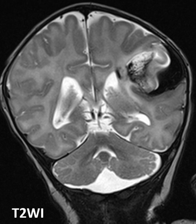 #AJNRcc >> October 11, 2021 >> What is the diagnosis for this term neonate with apneic events on day 1 of life? Submit your answer at ow.ly/cM9g50Gq06G.