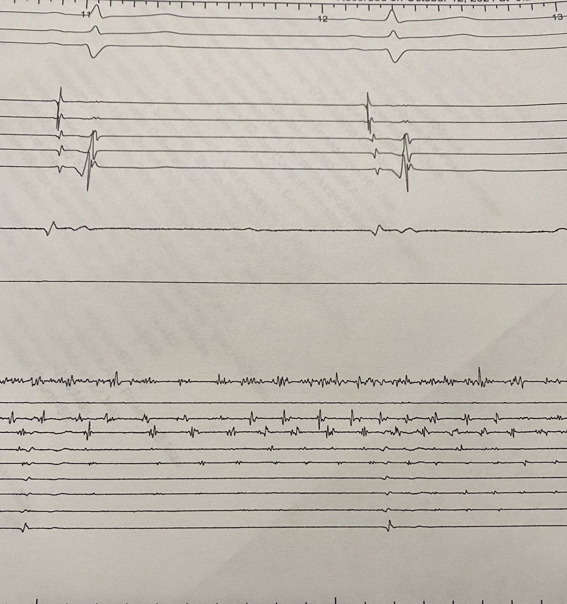 Left PV in Fib… sinus and sunny outside 😎
