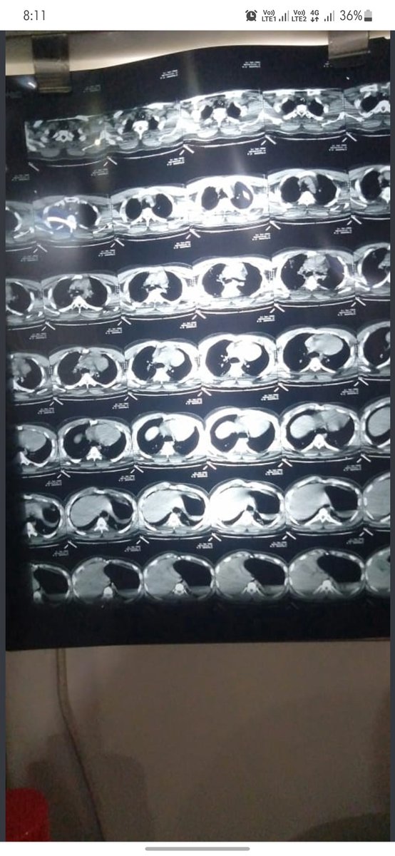 Kamali49382200's tweet photo. Respected everyone,our final year student Mr.srinivasalu met with an accident n now in critical condition with pulmonary thrombosis treatment is costing around 40L.Every money is countable.your valuable help may reach through 6302397580 - p.chakrapani/9030587558 hemakumar https://t.co/Q9pDMtfuPv