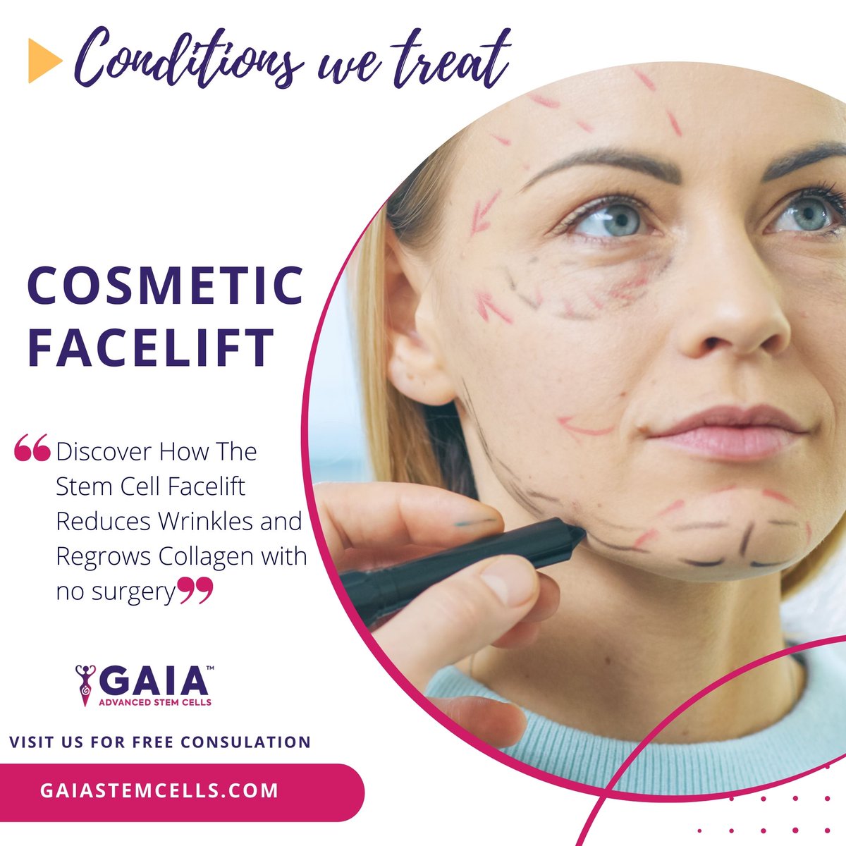 Discover how the stem cell face lift reduces wrinkles and regrows collagen that could last 15-20 years at gaiastemcells.com/cosmetic-facel…

DM us to assist you for FREE Consultation and Pricing.

#stemcelltheraphy #stemcellresearch #healthyandbeauty #GAIA