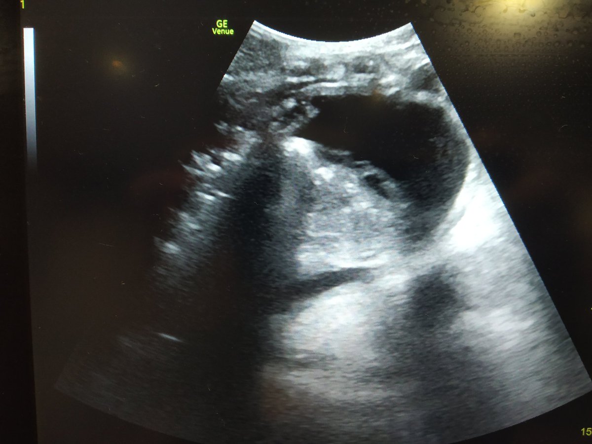 Common cause of drop in Hemoglobin, 👇large clot in stomach UGI variceal bleed #POCUS #Gastricultrasound