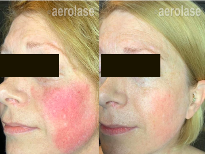 DrMooreSTL's tweet photo. Eliminate the Redness, Bumps, and Embarrassment of Rosacea in a Whole New Way
The Aerolase Neo Elite laser helps you reduce the erythema, telangiectasias, papules, and pustules of rosacea with quick treatments.
Learn my about our Aerolase Laser by giving us a call at 314.863.5556 https://t.co/GZxSbfbOib