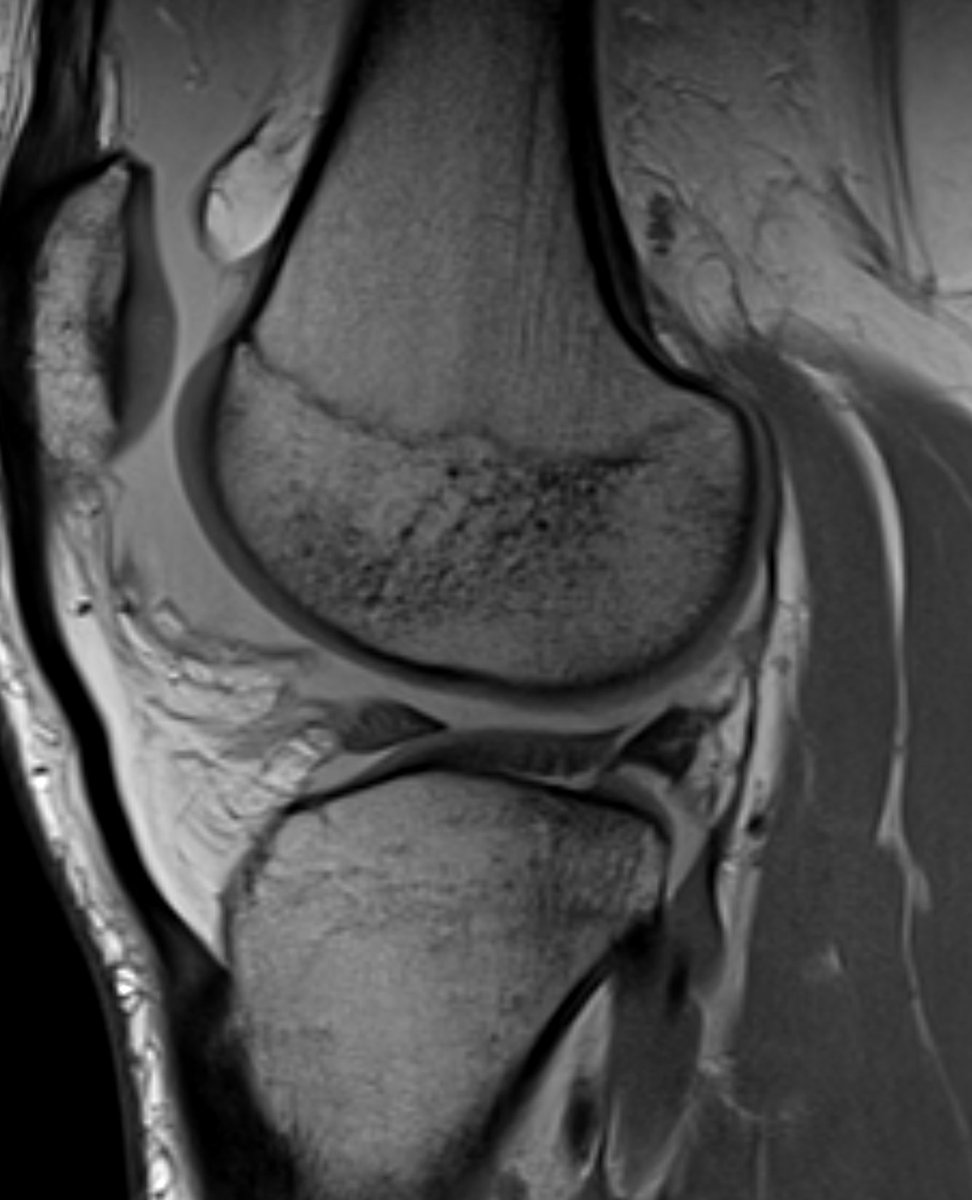 👀 Holy articular cartilage delamination Batman! Almost fitting the meniscus under that flap. How do you approach this in a young patient #orthotwitter ? #radres #MedTwitter #sportsmedicine