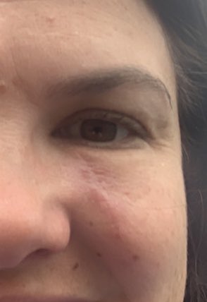 My scars remind me I can do hard things. Not a day goes by I don’t notice them, but I know I am stronger because of them. #curemelanoma