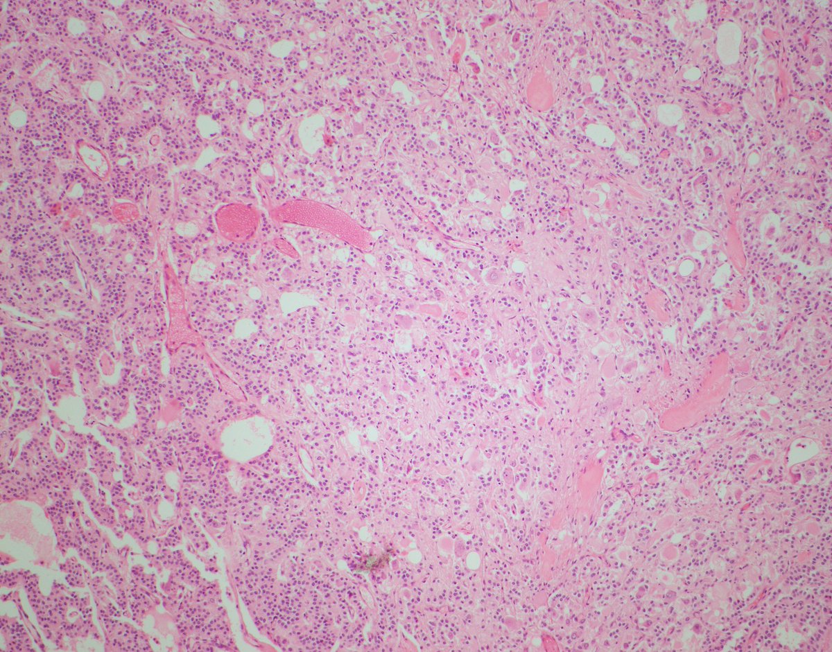 CaDxPath's tweet photo. When is a 'paraganglioma' not a paraganglioma? Thread 1/2

This from the cauda equina of a middle aged patient.

The diagnosis is "paraganglioma" of the cauda equina? But is this tumour called a paraganglioma really a paraganglioma https://t.co/P3KtkAOOSk