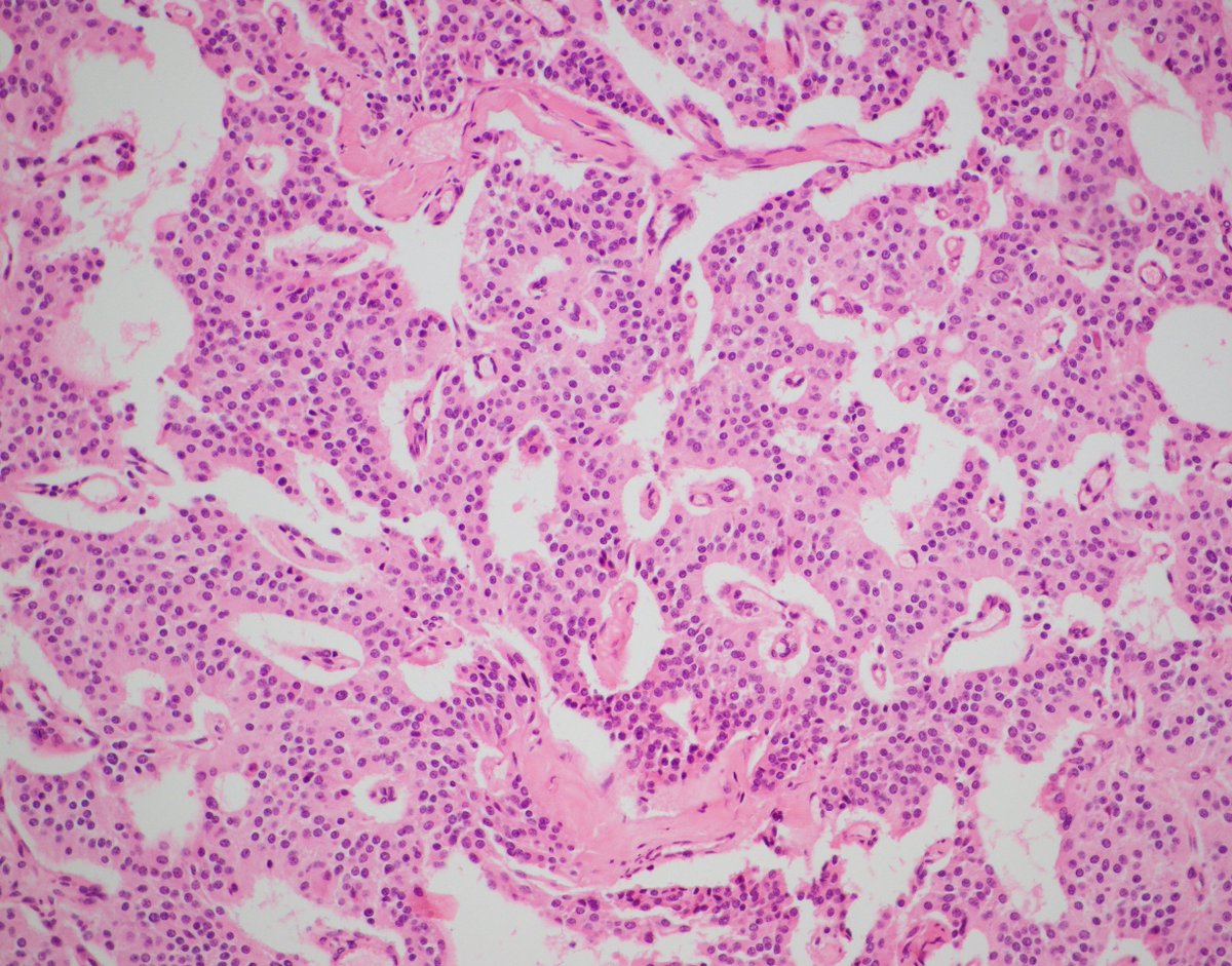 CaDxPath's tweet photo. When is a 'paraganglioma' not a paraganglioma? Thread 1/2

This from the cauda equina of a middle aged patient.

The diagnosis is "paraganglioma" of the cauda equina? But is this tumour called a paraganglioma really a paraganglioma https://t.co/P3KtkAOOSk