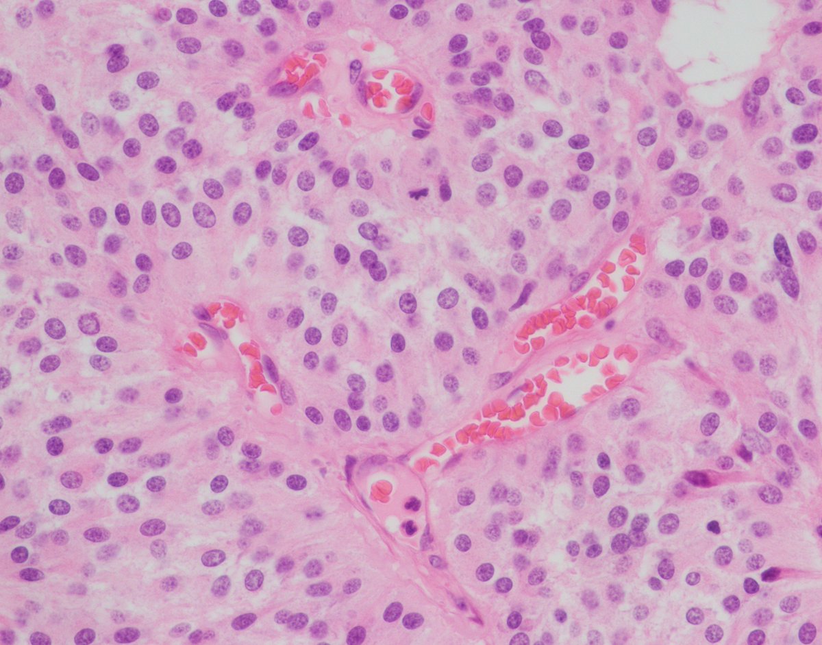 When is a 'paraganglioma' not a paraganglioma? Thread 1/2

This from the cauda equina of a middle aged patient.

The diagnosis is "paraganglioma" of the cauda equina? But is this tumour called a paraganglioma really a paraganglioma