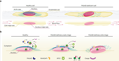 CircAHA's tweet photo. #OriginalResearch In calcified aortic valve stenosis, ⬇️ PALMD expression ➡️ nuclear arrest of XPO1 cargo, gene regulatory changes and loss of actin-dependant nuclear resilience https://t.co/b8Wc5lzQIR #AHAJournals @TransCardio @ClaessonWelsh https://t.co/Z4TmHkoFJe