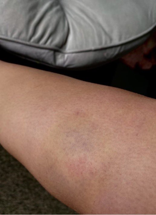 BloomRugby's tweet photo. ‼️It’s Tuesday Bruiseday‼️

Bruises courtesy of: 
1. Hope 
2. Livi 
3. Syd 
4. Kaleigh https://t.co/0kQBBtmgs6