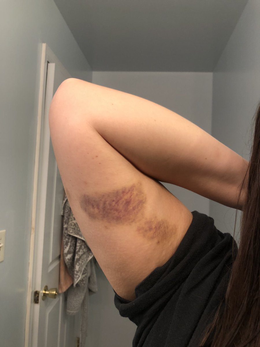 BloomRugby's tweet photo. ‼️It’s Tuesday Bruiseday‼️

Bruises courtesy of: 
1. Hope 
2. Livi 
3. Syd 
4. Kaleigh https://t.co/0kQBBtmgs6