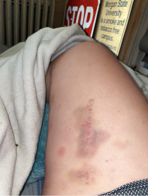 BloomRugby's tweet photo. ‼️It’s Tuesday Bruiseday‼️

Bruises courtesy of: 
1. Hope 
2. Livi 
3. Syd 
4. Kaleigh https://t.co/0kQBBtmgs6