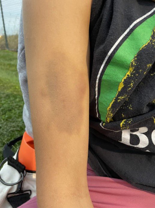 BloomRugby's tweet photo. ‼️It’s Tuesday Bruiseday‼️

Bruises courtesy of: 
1. Hope 
2. Livi 
3. Syd 
4. Kaleigh https://t.co/0kQBBtmgs6